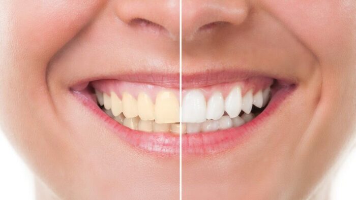 The Hidden Dental Benefits of Garlic: A Natural Way to a Healthier, Brighter Smile